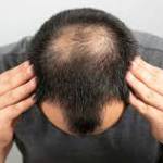 Hair Transplant In India Profile Picture