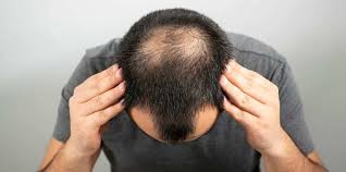Hair Transplant In India Profile Picture