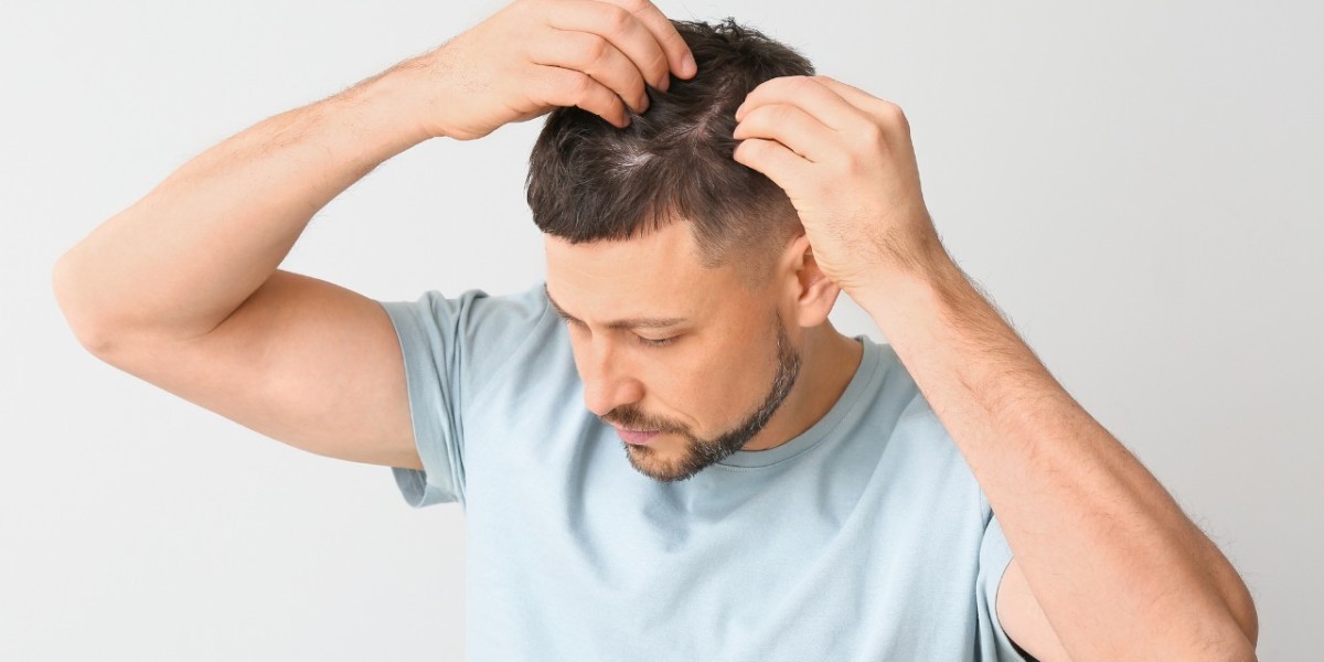 3000 grafts Hair Transplant Cost in India
