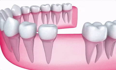 Dental Implants Treatment in Jaipur | Dental Seva Clinic